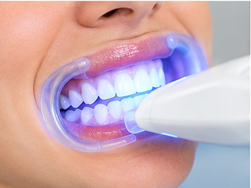 Teeth whitening