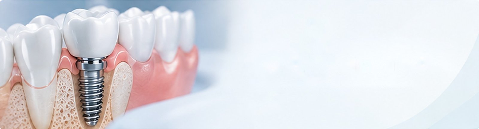 Dental implants in Valencia | Clínica Dental Baleares